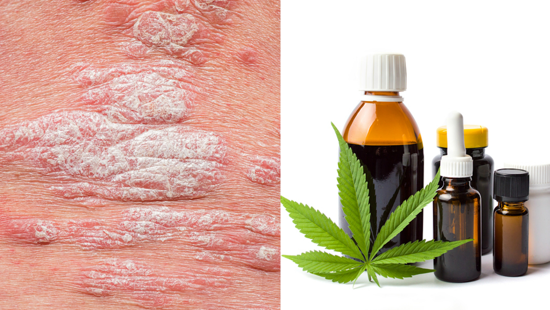 CBD Oil for Eczema Does it Work? Cannabis Legale